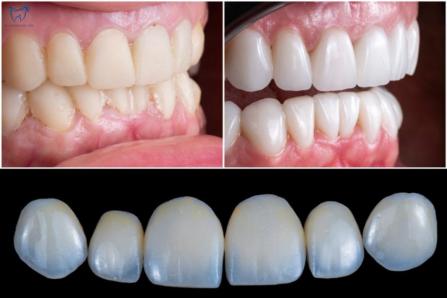 Nha Khoa Quốc Tế Sài Gòn Dán sứ siêu mỏng giúp bảo tồn răng thật tối đa