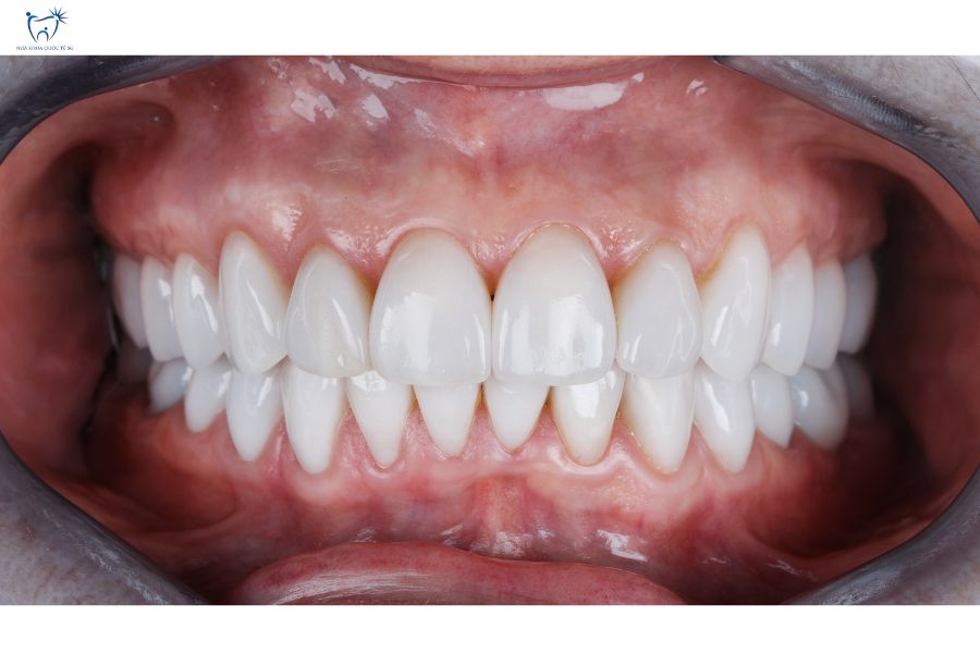 Nha Khoa Quốc Tế Sài Gòn Dán sứ E-max có độ trắng sáng tự nhiên như răng thật