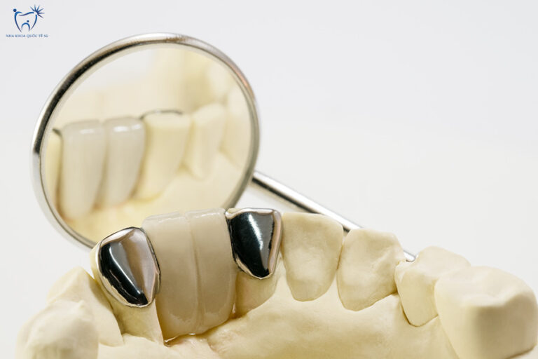 Nha Khoa Quốc Tế Sài Gòn Cần thay răng sứ Titan khi hết hạn sử dụng