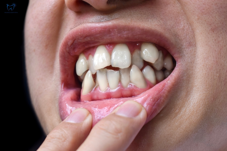 Nha Khoa Quốc Tế Sài Gòn Tình trạng răng chen chúc nặng
