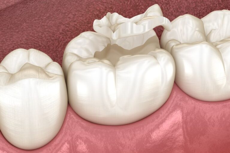 Nha Khoa Quốc Tế Sài Gòn Nên chọn loại răng sứ phù hợp với mục đích cá nhân