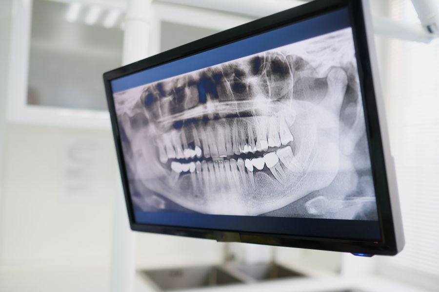 Nha Khoa Quốc Tế Sài Gòn Có nhiều nghiên cứu về răng sứ Titan