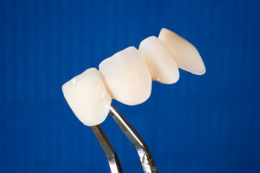 Răng sứ toàn sứ được chế tác hoàn toàn từ vật liệu sứ