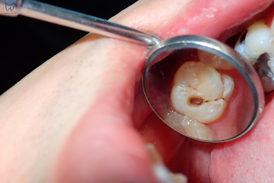 Nha Khoa Quốc Tế Sài Gòn Trường hợp bị sâu răng nhẹ có thể dán sứ
