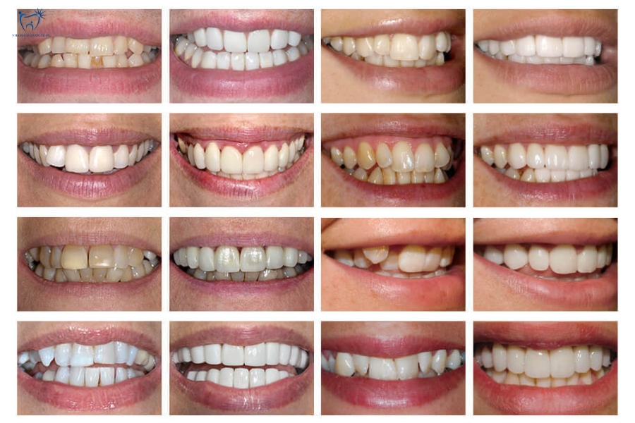 Nha Khoa Quốc Tế Sài Gòn So sánh răng khấp khểnh nhẹ trước và sau dán Veneer