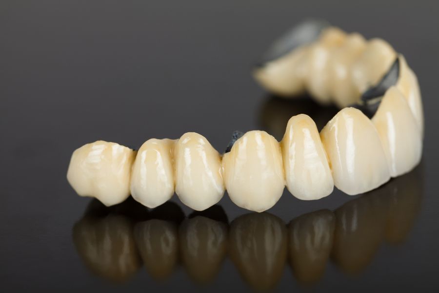Cầu răng sứ Titan có ưu và nhược điểm riêng biệt