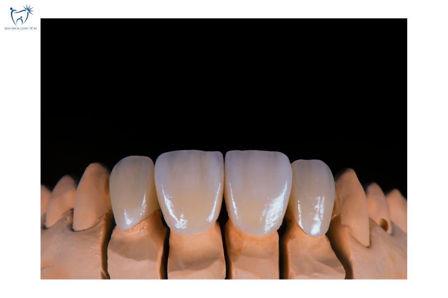 Nha Khoa Quốc Tế Sài Gòn Mỗi loại dán Veneer sẽ phù hợp với từng nhu cầu riêng của mỗi người