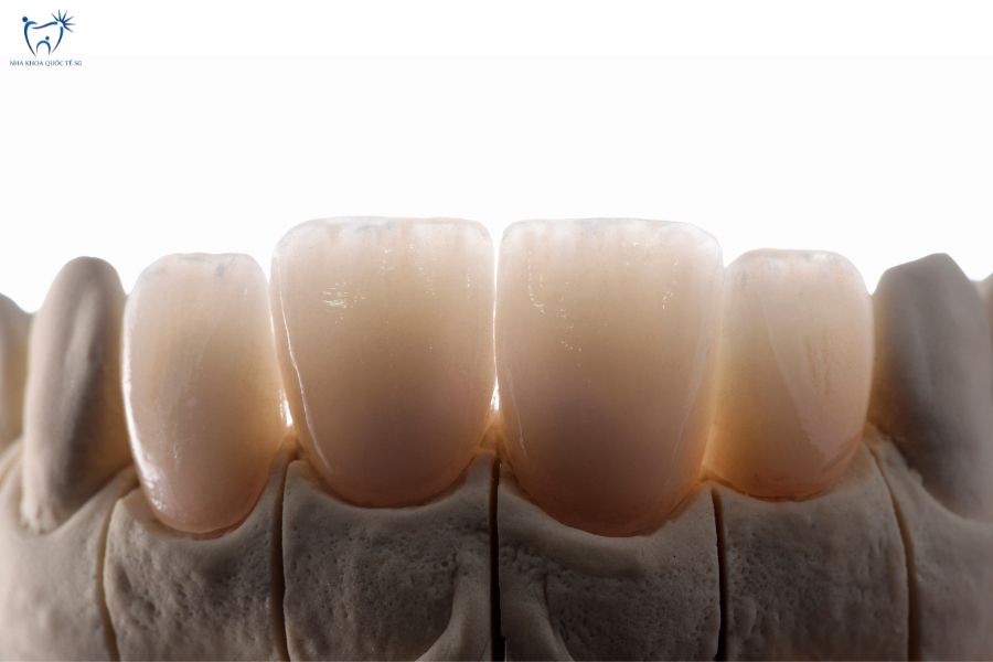 Nha Khoa Quốc Tế Sài Gòn Dán sứ Veneer siêu mỏng giúp bảo tồn răng thật tối đa