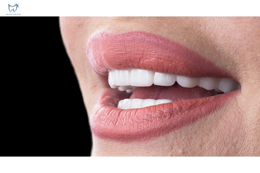 Nha Khoa Quốc Tế Sài Gòn Nụ cười sau khi dán răng sứ Veneer