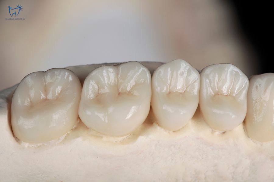 Răng sứ Zirconia sau khi hoàn thiện và gắn thử trên mẫu hàm