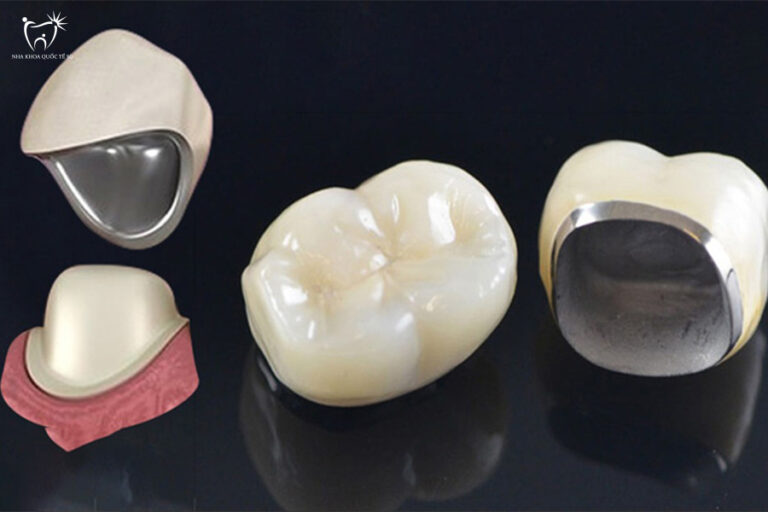 Cấu trúc răng sứ kim loại