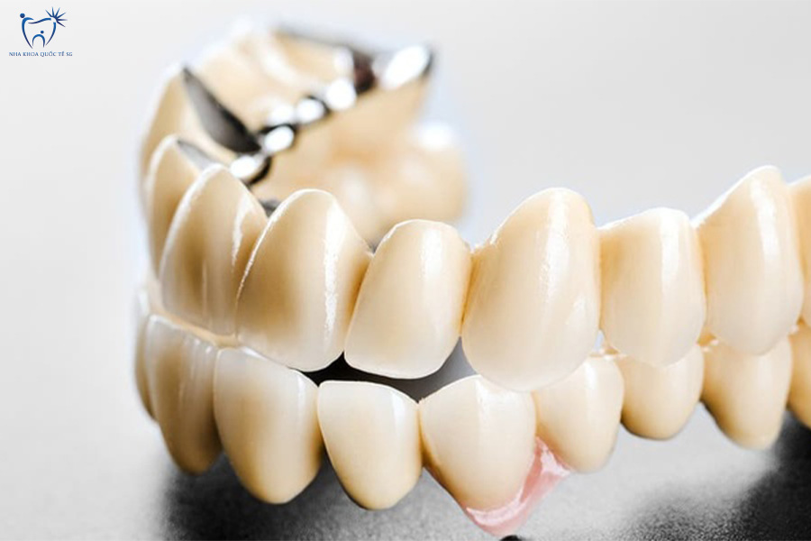 Răng sứ kim loại cho thấy lớp sườn kim loại bên trong và lớp sứ thẩm mỹ