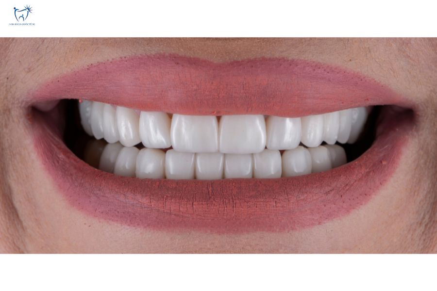 Nha Khoa Quốc Tế Sài Gòn Nụ cười rạng rỡ sau khi gắn răng sứ