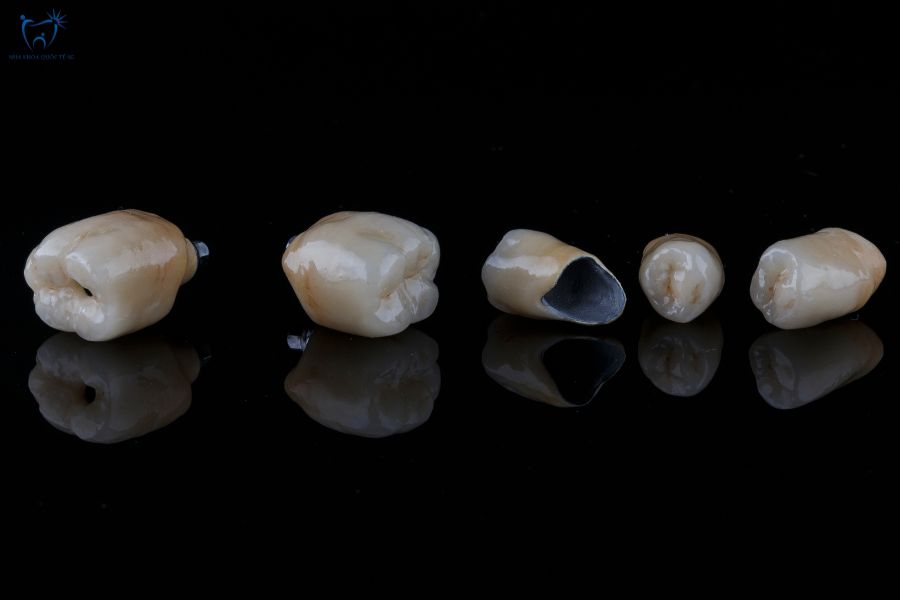 Nha Khoa Quốc Tế Sài Gòn Răng sứ kim loại gồm hai cấu trúc chính