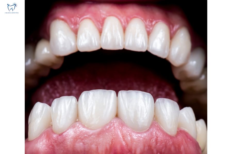 Nha Khoa Quốc Tế Sài Gòn Chăm sóc tốt giúp răng sứ kéo dài tuổi thọ