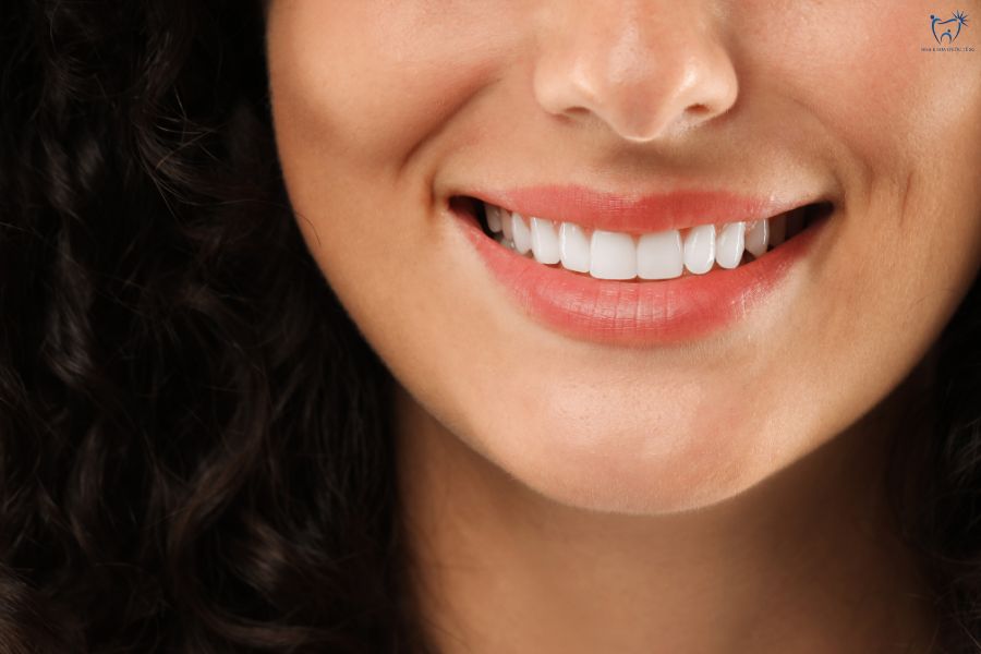 Chọn loại Veneer phù hợp giúp bạn có nụ cười rạng rỡ