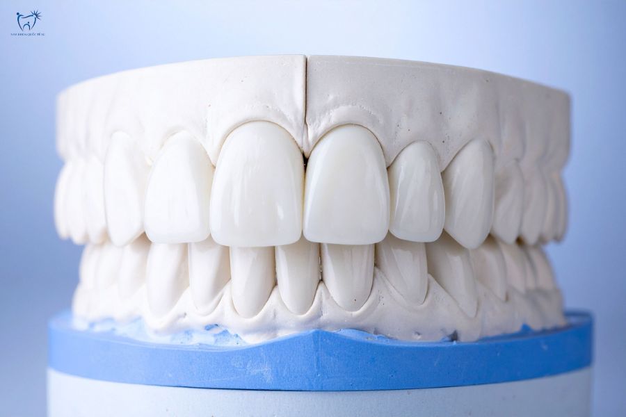 Nha Khoa Quốc Tế Sài Gòn Dán sứ và bọc sứ là phương pháp điều trị răng khác nhau