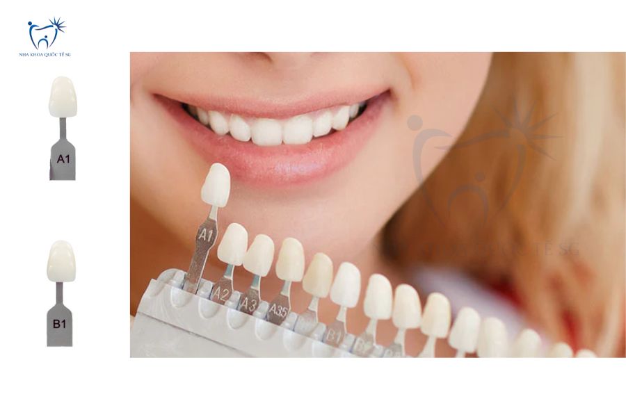 Màu răng sứ A1 và B1 với bảng màu VITA Classic 