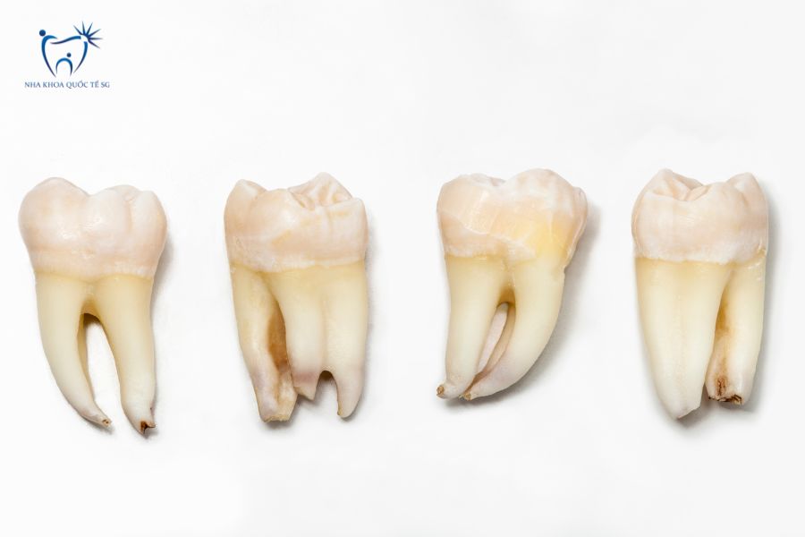 Màu cùi răng thật (răng gốc) ảnh hưởng trực tiếp đến kết quả màu sứ