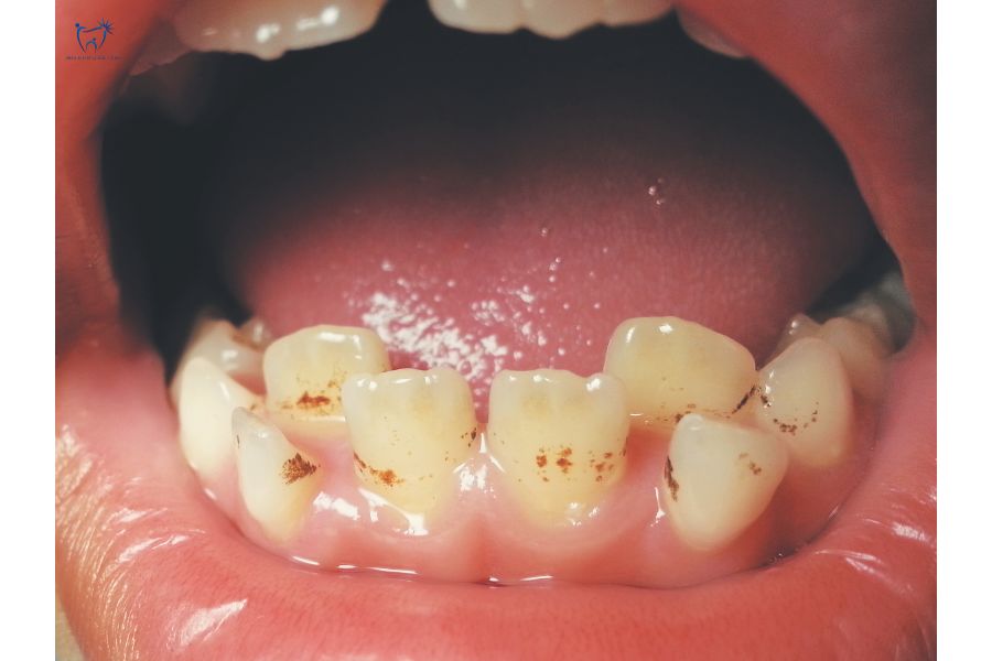 Nha Khoa Quốc Tế Sài Gòn Tình trạng răng không đều nặng không nên dán sứ