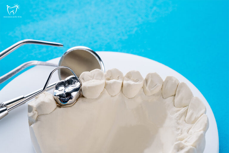 Cận cảnh một mão răng kim loại trên mẫu hàm thạch cao