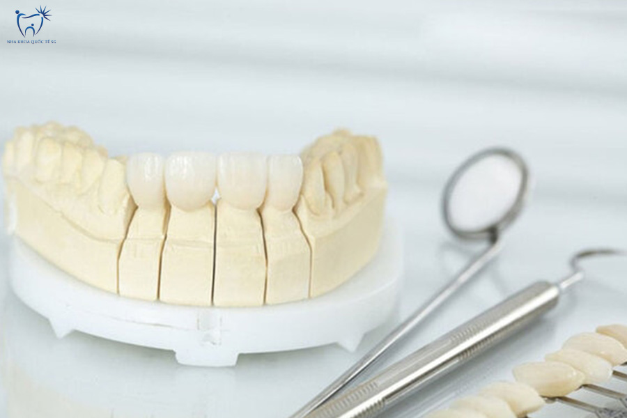 Nha Khoa Quốc Tế Sài Gòn Mẫu hàm răng sứ kim loại