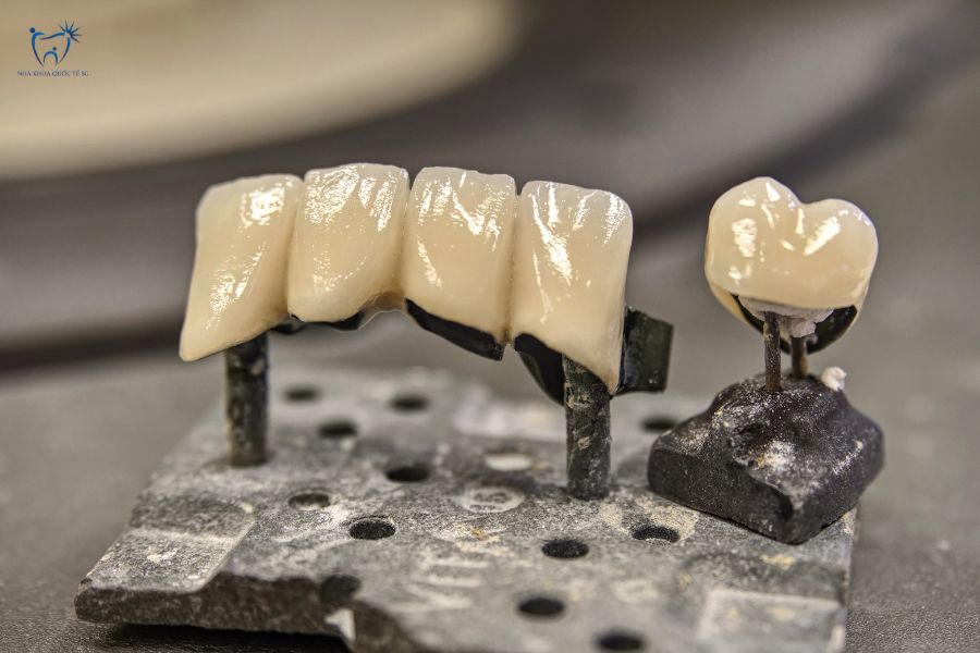 Răng sứ kim loại làm từ hợp kim từ kim loại