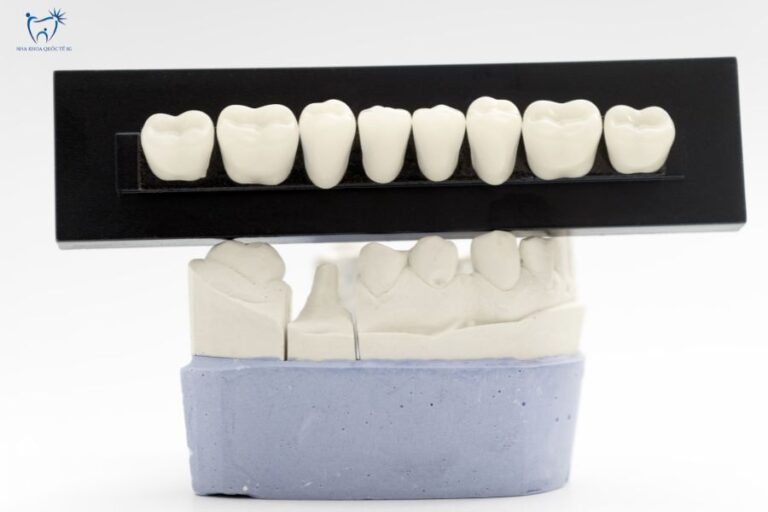 Mô hình răng sứ Zirconia được chế tác trên khung mẫu thạch cao