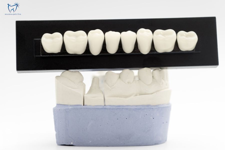 Mô hình răng sứ Zirconia được chế tác trên khung mẫu thạch cao