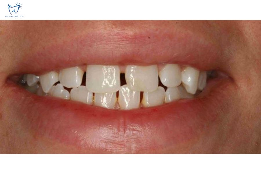 Nha Khoa Quốc Tế Sài Gòn Tình trạng răng bị thưa nhẹ có thể dán sứ