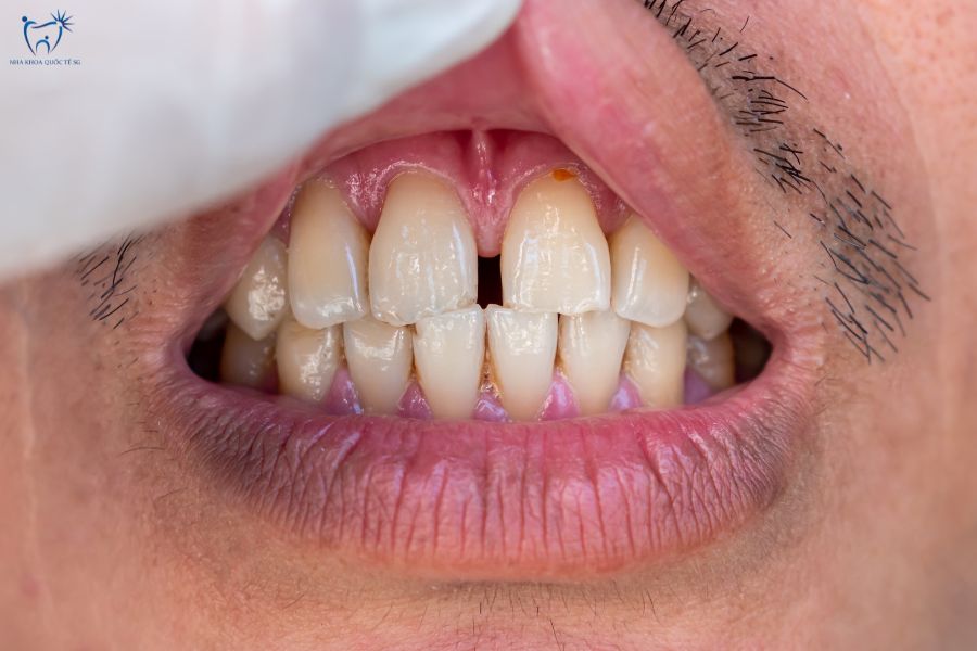 Nha Khoa Quốc Tế Sài Gòn Trường hợp răng thưa nhẹ có thể dán Veneer