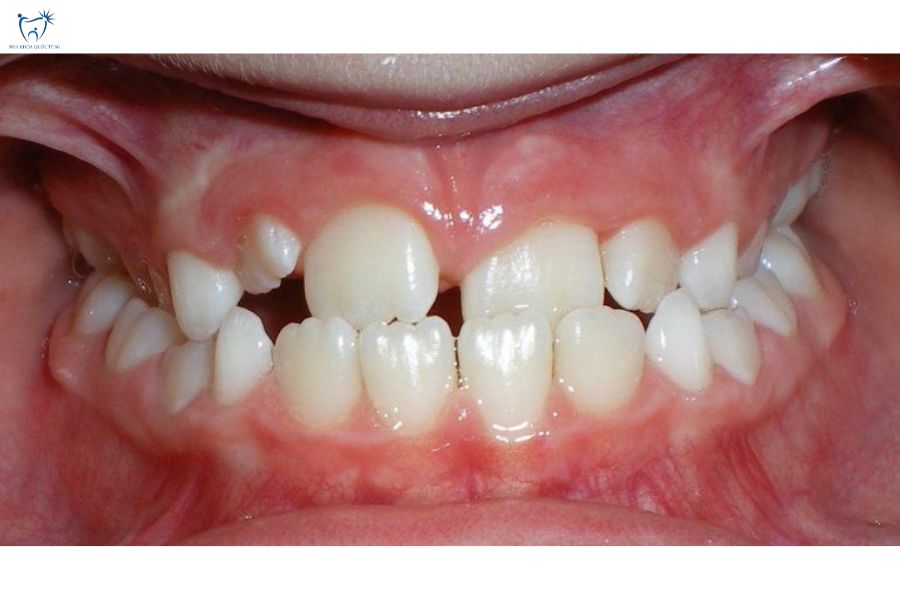 Nha Khoa Quốc Tế Sài Gòn Trường hợp răng thưa nặng, mọc chen chúc không nên dán Veneer