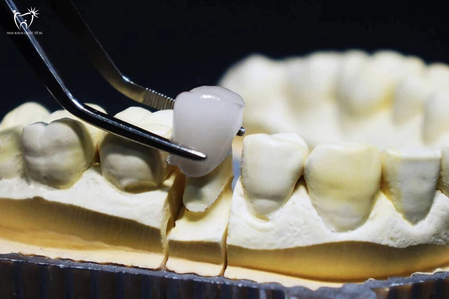 Nha Khoa Quốc Tế Sài Gòn Mô tả mão răng được đặt lên mẫu hàm