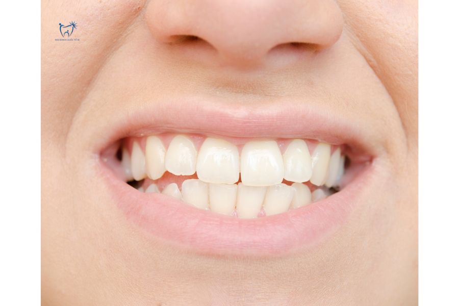 Nha Khoa Quốc Tế Sài Gòn Tuổi thọ thực tế răng sứ Zirconia HT cao so với các dòng khác