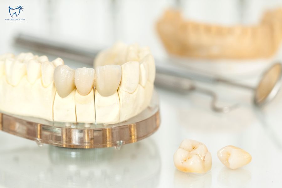 Nha Khoa Quốc Tế Sài Gòn Các mão răng sứ toàn sứ có màu sắc tự nhiên, lành tính