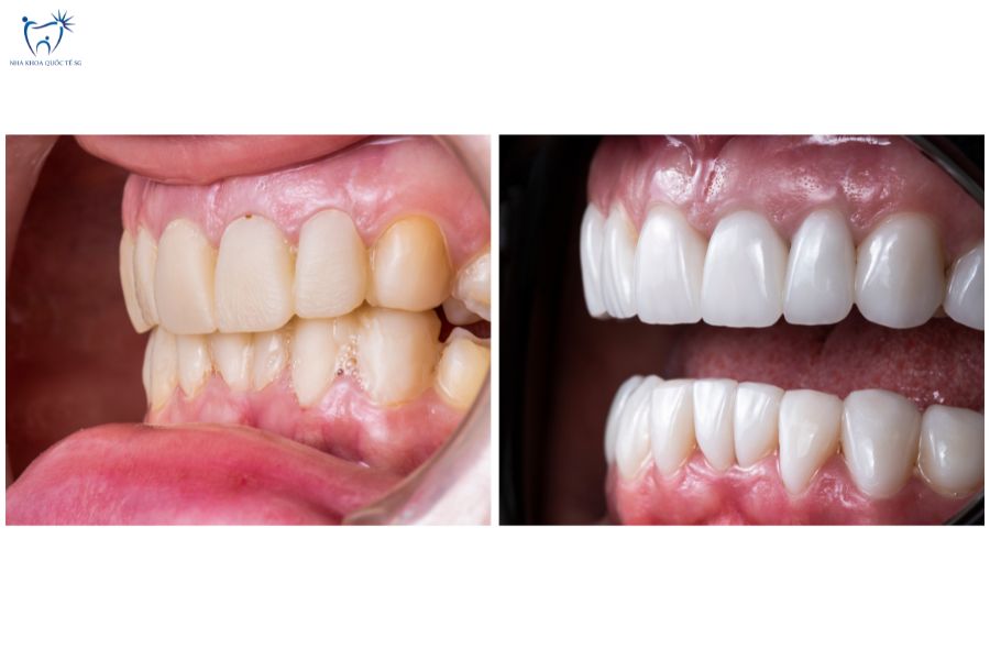 Nha Khoa Quốc Tế Sài Gòn Kết quả trước và sau khi dán sứ Veneer