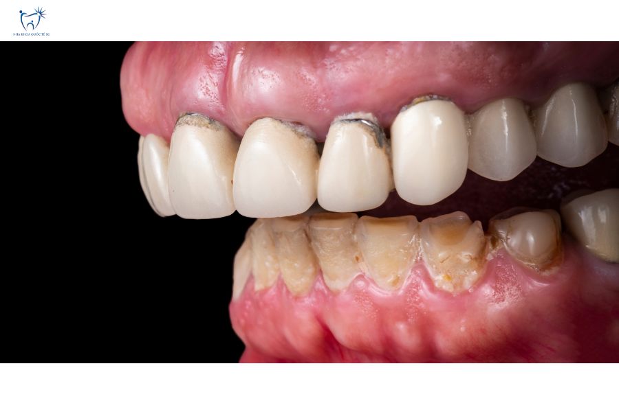 Nha Khoa Quốc Tế Sài Gòn Răng sứ kim loại có khả năng đen viền nướu