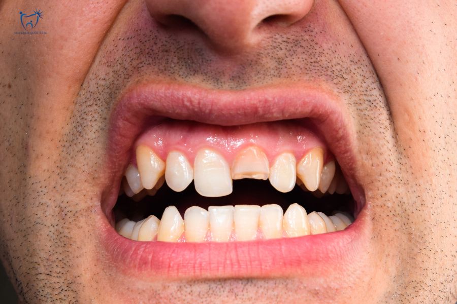 Nha Khoa Quốc Tế Sài Gòn Khách hàng bị mẻ răng do dùng lực cắn quá mạnh