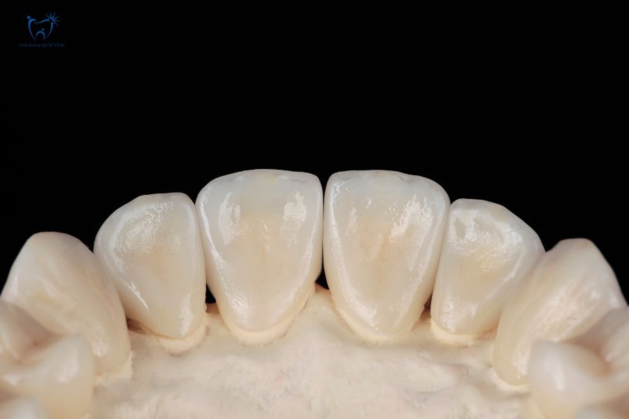 Mô phỏng răng sứ toàn sứ hình dáng và màu sắc