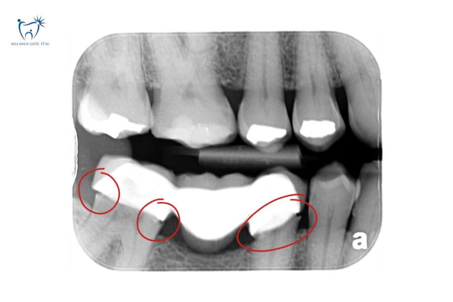 Ảnh chụp CT cầu răng sứ bị hở cần điều trị
