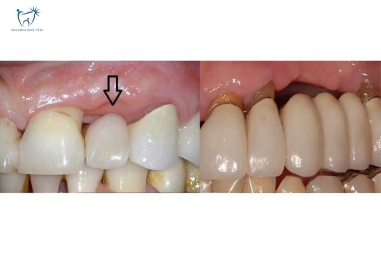 Hình ảnh thực tế cầu răng sứ bị hở
