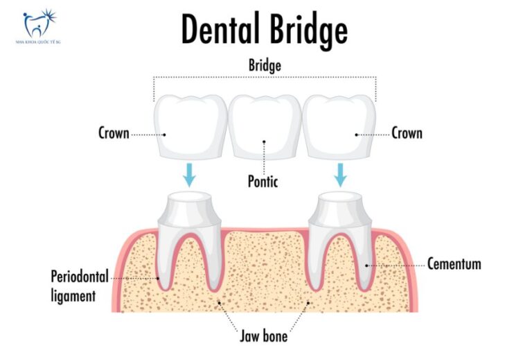 Cấu tạo chi tiết cầu răng sứ