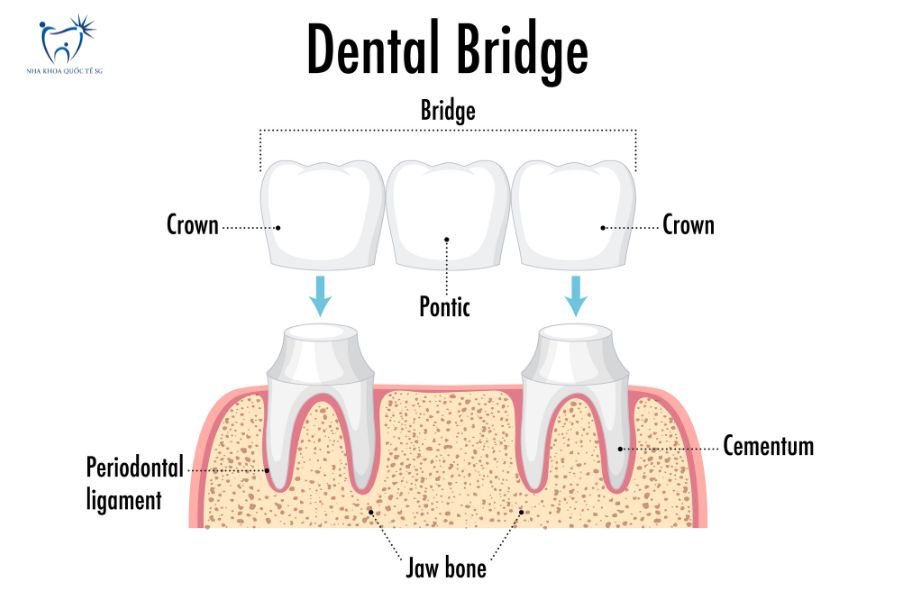 Cấu tạo chi tiết cầu răng sứ