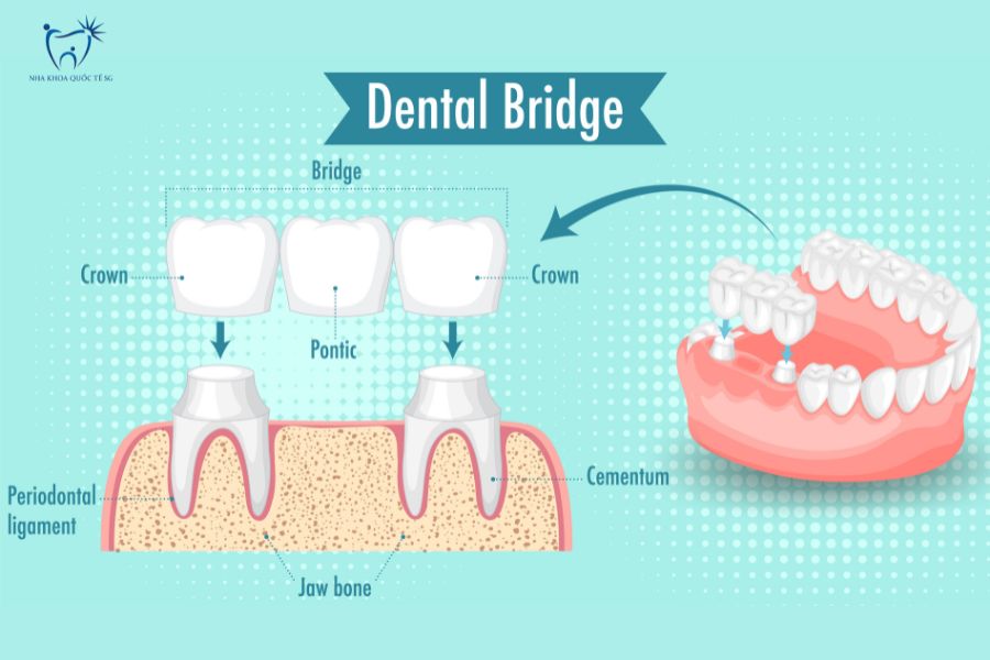 Cấu tạo chi tiết cầu răng sứ được gắn trên răng thật