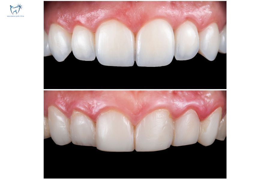 Nha Khoa Quốc Tế Sài Gòn Hình ảnh trước và sau khi dán Laminate