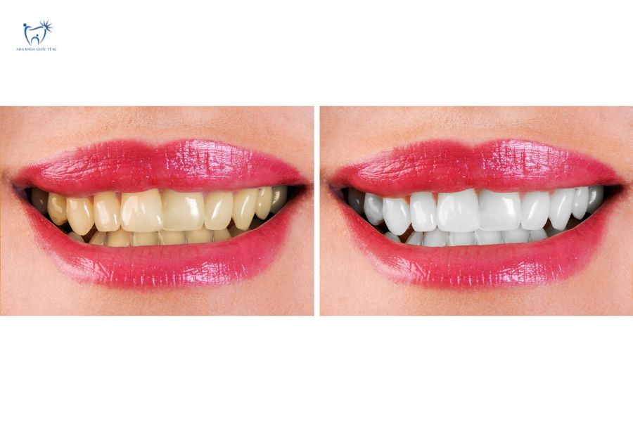 Nha Khoa Quốc Tế Sài Gòn Tình trạng răng trước và sau khi dán sứ Lisi