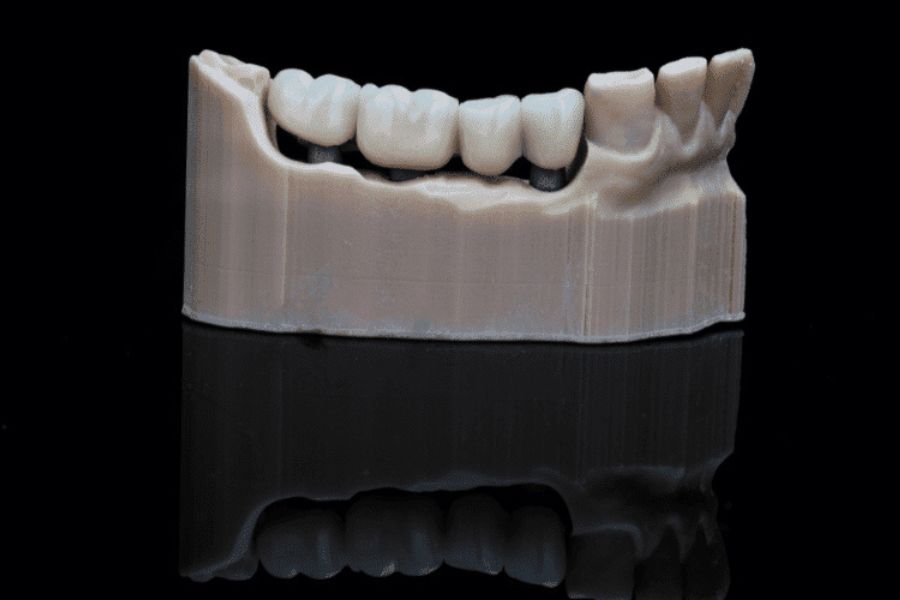 Mô hình cầu răng sứ trên Implant