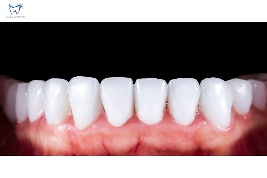 Nha Khoa Quốc Tế Sài Gòn Răng được phục hình sứ cho thấy đồng đều về màu sắc và hình dáng