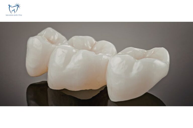 Mô hình cầu răng sứ gồm ba mão sứ