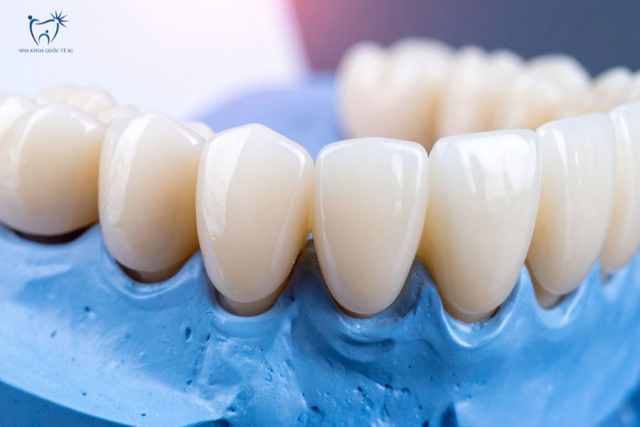 Nhược điểm cần lưu ý khi làm cầu răng sứ